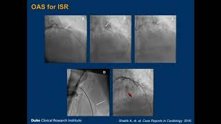 What is Laser Atherectomy  Lam Vascular and Associates [upl. by Ylehsa]