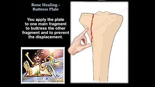 Bone Healing Buttress Plate  Everything You Need To Know  Dr Nabil Ebraheim [upl. by Stefanie]