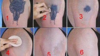 How to Remove a Tattoo without Laser at Home [upl. by Ati]