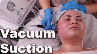 Vacuum suction facial treatment  avoid pore bruising step by step demo 2021 [upl. by Lamraj]