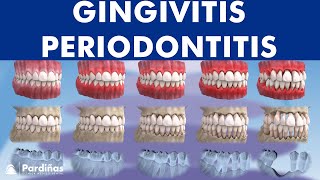 Gingivitis and Periodontitis  Evolution © [upl. by Anole]