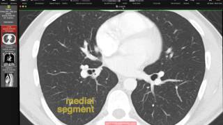 Lumbar Spinal Stenosis  Everything You Need To Know  Dr Nabil Ebraheim [upl. by Lambrecht389]