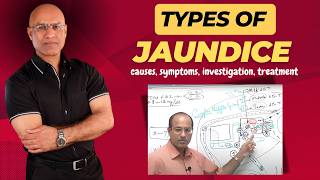 Types of Jaundice in Newborn [upl. by Marilou]