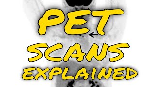 How do PET scans work to detect things such as cancer [upl. by Refotsirk899]