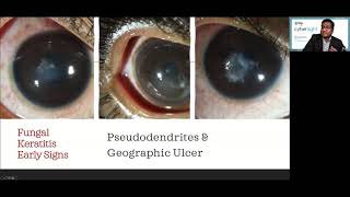 Lecture Microbial Keratitis Update for General Ophthalmologists [upl. by Aidnyc]