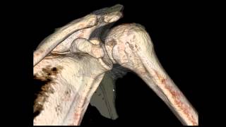 Posterior Shoulder Dislocation [upl. by Eitsirc]