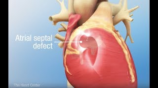 Ventricular Septal Defect slow [upl. by Eddra684]