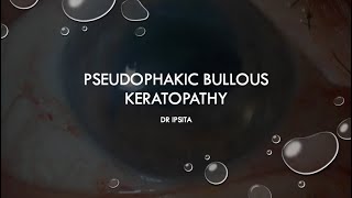 PSEUDOPHAKIC BULLOUS KERATOPATHY [upl. by Fabi]