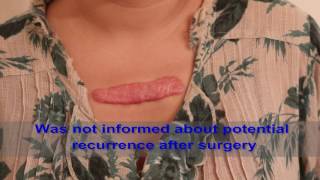 Chest Keloids  Mistakes to Avoid [upl. by Alvan963]