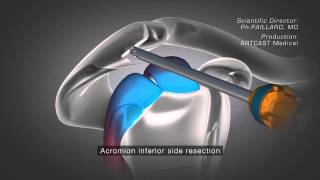 Shoulder Arthroscopy  Acromioplasty [upl. by Roxanne]