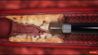 Atherectomy for Peripheral Arterial Occlusive Disease  Part 2 [upl. by Suter328]