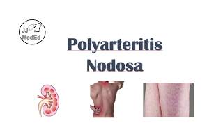 Polyarteritis Nodosa PAN  Signs amp Symptoms Diagnosis Treatment [upl. by Patrica]