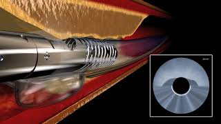 Laser Atherectomy Video Coronary amp Peripheral [upl. by Nailij]