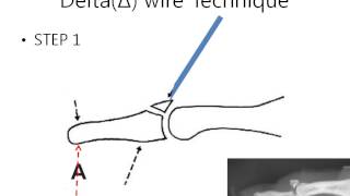 Delta wire Technique Bony Mallet Finger [upl. by Hickey]