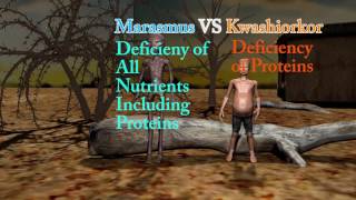 Marasmus Difference Between Marasmus Cachexia and Kwashiorkor [upl. by Anyek391]