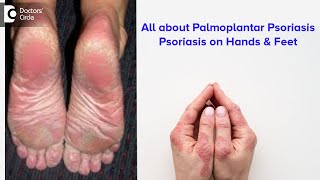 All about Palmoplantar Psoriasis  Psoriasis on hands amp feet  Dr Rajdeep Mysore  Doctors Circle [upl. by Katie]