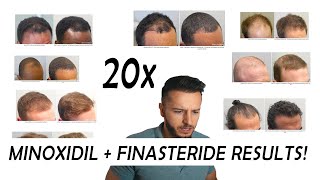 20 Finasteride and Minoxidil before and after Results NW2  NW56 [upl. by Cheslie]