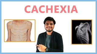 Cachexia Medical Symptom [upl. by Adrahc]