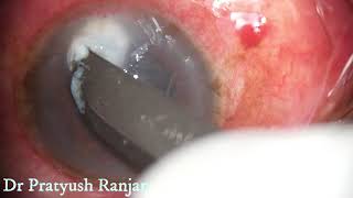 Therapeutic Corneal Ulcer Scraping [upl. by Christianna]