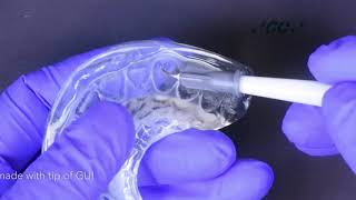 Injection moulding technique with GC Exaclear Gaenial Universal Injectable [upl. by Erland]