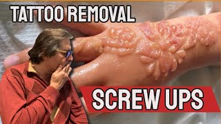 Laser Tattoo Removal Screw Ups [upl. by Hecker]