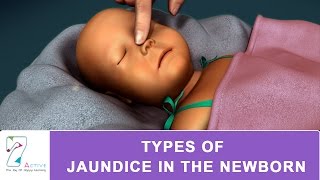 How to screen for neonatal jaundice [upl. by Raphaela]