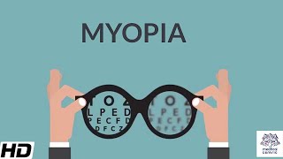 Myopia Signs and Symptoms Causes Diagnosis and Treatment [upl. by Nomrac459]