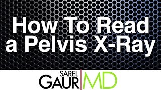 How to Read a Pelvis Xray [upl. by Enilrek]