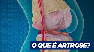 O QUE É ARTROSE [upl. by Luigi]