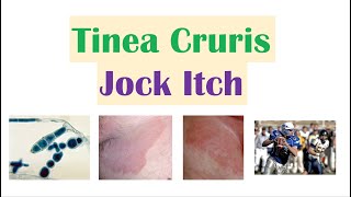 Jock Itch Tinea Cruris  Causes Risk Factors Signs amp Symptoms Diagnosis and Treatment [upl. by Ylac]