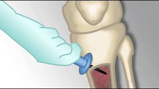 Placement of an Intraosseous Line by MKleinman  OPENPediatrics [upl. by Ellekcim]