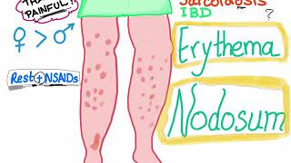 Erythema Nodosum [upl. by Aicnerolf678]