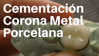 CORONA 👅 METAL PORCELANA Cementación coronadental [upl. by Suciram]