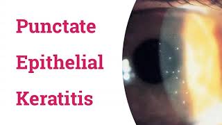 Punctate Epithelial Keratitis PEK [upl. by Shir804]