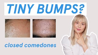 Why those tiny bumps AREN’T fungal acne [upl. by Ellennaj]