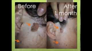 Natural treatment for seborrheic keratosis before and after photos [upl. by Nail]