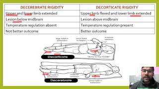 DIFFERENCE BETWEEN DECEREBRATE AND DECORTICATE RIGIDITY DECORTICATERIGIDITY DECEREBRATERIGIDITY [upl. by Carlotta]