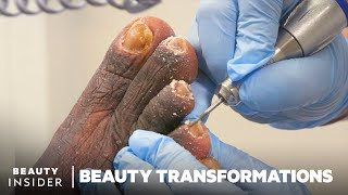 How Medical Pedicures Transform Feet [upl. by Lobel]