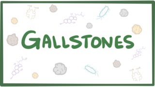 Gallstones cholelithiasis [upl. by Nosylla]