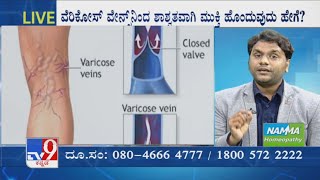 Nimma Doctor  Homeopathic Treatment For Varicose Veins  Namma Homeopathy [upl. by Leifer380]