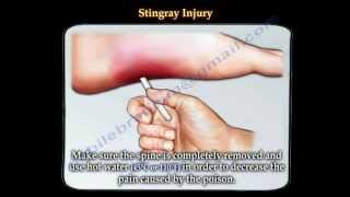 Stingray fish injury  Everything You Need To Know  Dr Nabil Ebraheim [upl. by Oiznun448]