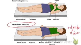 Decerebrate Vs Decorticate Posturing [upl. by Wixted]