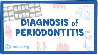 Diagnosis of Periodontitis [upl. by Cletus]