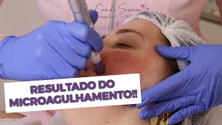 Resultados do Microagulhamento  Antes e Depois  Tratamento para Cicatriz de Acne [upl. by Erleena283]