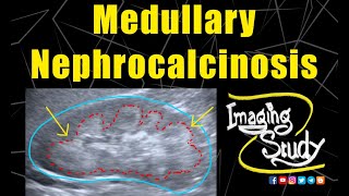 Medullary Nephrocalcinosis  Ultrasound  Case 128 [upl. by Rugen]