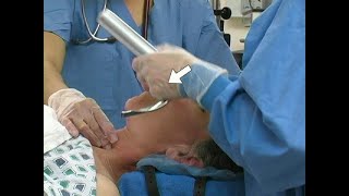 Orotracheal Intubation [upl. by Hecker]