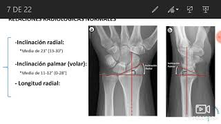 FRACTURAS DE RADIO DISTAL REVISIÓN DEL TEMA [upl. by Basham]