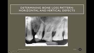 Interpretation of Periodontal Disease Source [upl. by Aniroz]