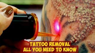 Tattoo Removal ► All You Need To Know [upl. by Lauritz336]