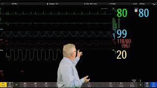 Philips IntelliVue Patient Monitoring  4  Changing Wave Order [upl. by Mikkanen]